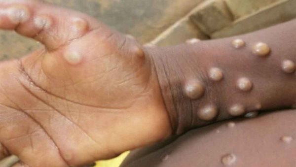 Suspected case of monkeypox in Kerala, sample sent for testing