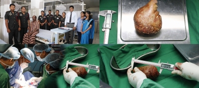 SL Army Doctors Set Guinness Record after Removing World's Largest & Heaviest Kidney Stone