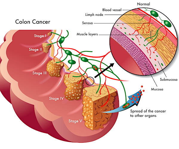 Medical illustration of the different stages of colon cancer